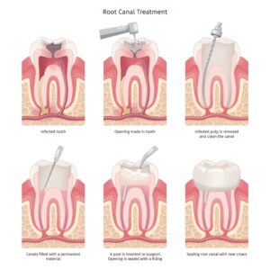 DENT Edremit Kanal Tedavisi (Endodonti)